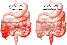 پاورپوینت کولیت اولسروز و کرون (ppt) 35 اسلاید